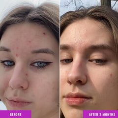Good Molecules Niacinamide Serum Pack 2 applied to the face for even tone.