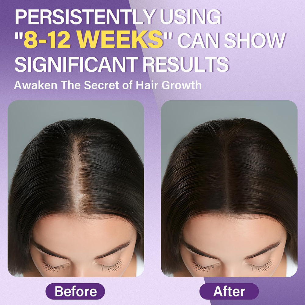 Greoay minoxidil foam application on the scalp for targeted care.