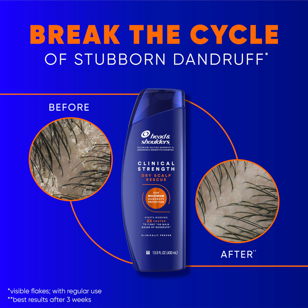 Head & Shoulders dandruff flakes close-up illustrating visible flake reduction