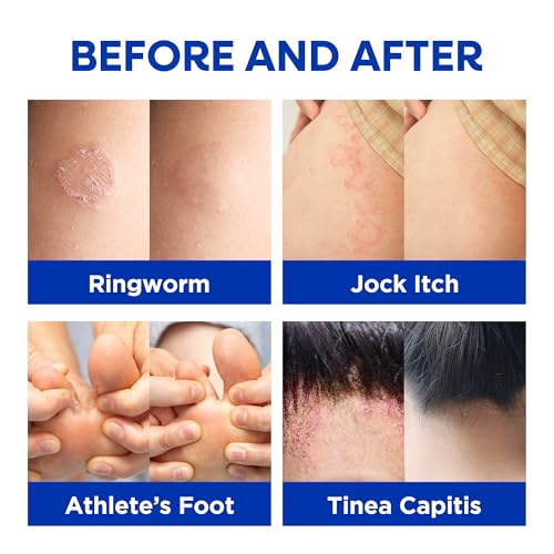 Hermon Antifungal Cream on skin shows soothing application.