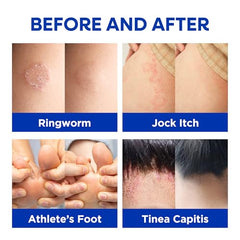 Hermon Antifungal Cream on skin shows soothing application.