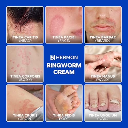Hermon Antifungal Cream 100ml packaging highlights travel-friendly size.