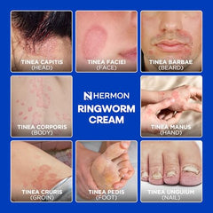 Hermon Antifungal Cream 100ml packaging highlights travel-friendly size.