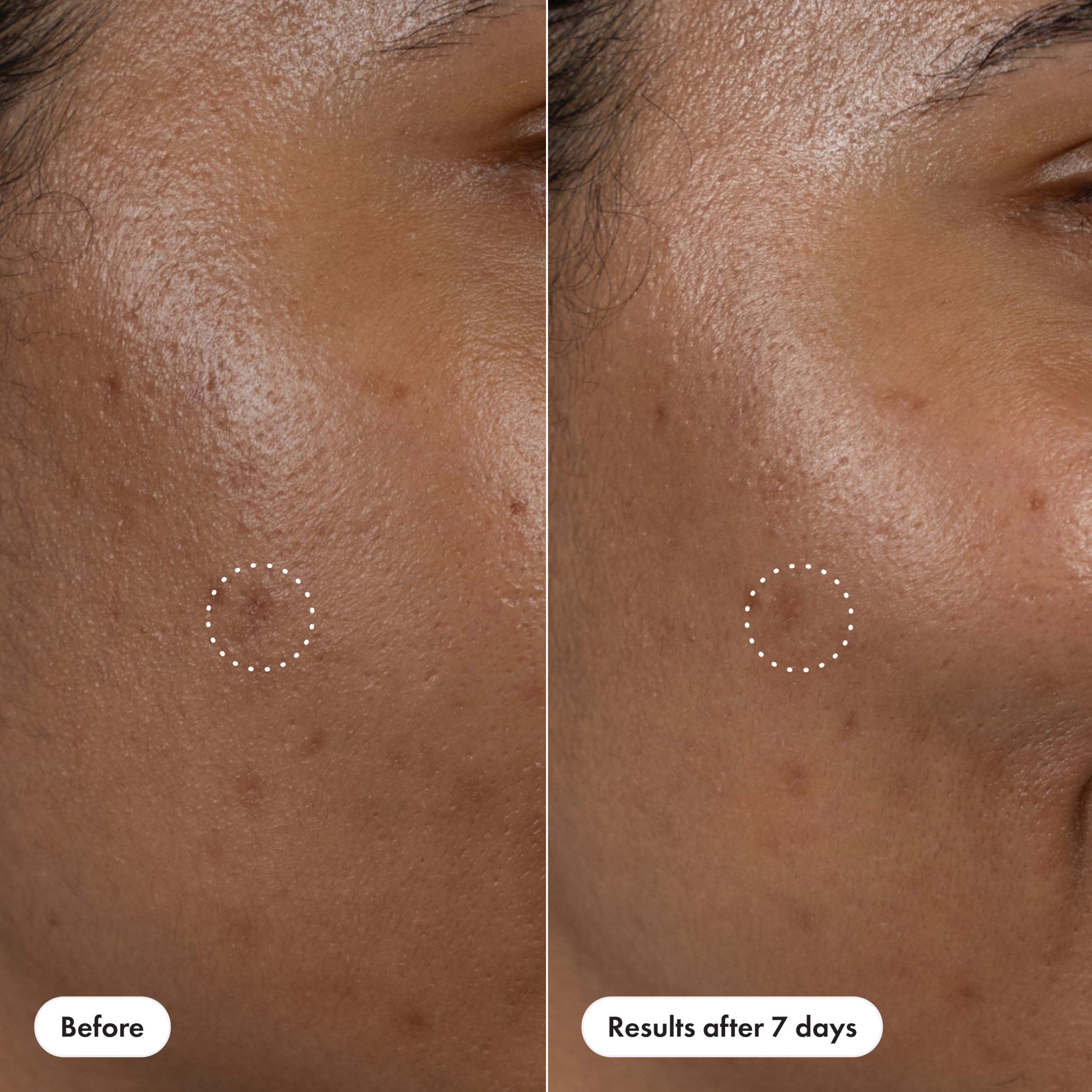 Potential 7-day improvement in post-blemish appearance during real-life use.