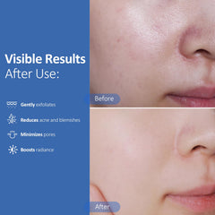 Hicream Glycolic Acid Pads tube and pads view for easy post-cleansing toning