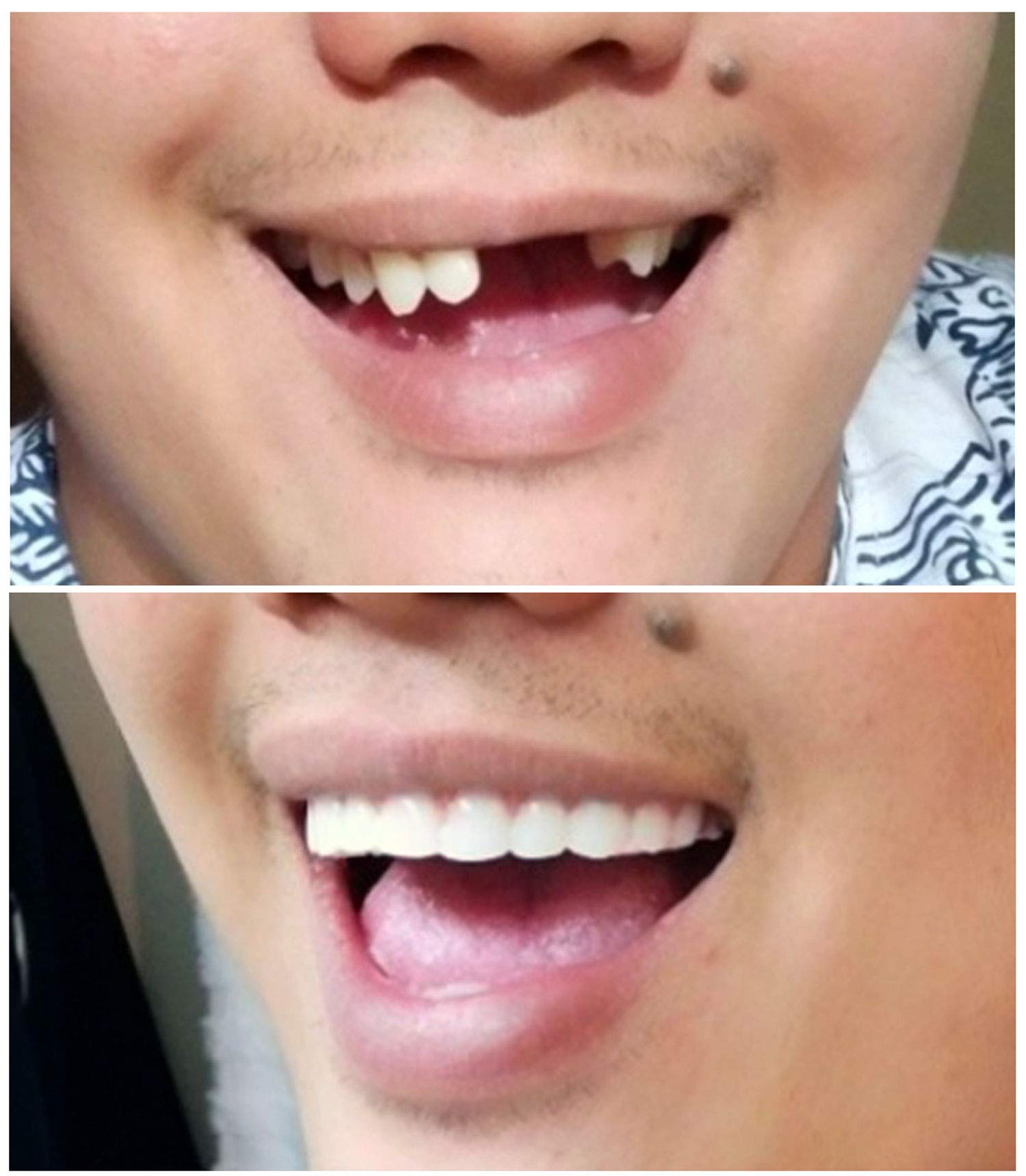 Instant Smile Comfort Fit Flex thin-flex technology image suggests minimal speech interruption.