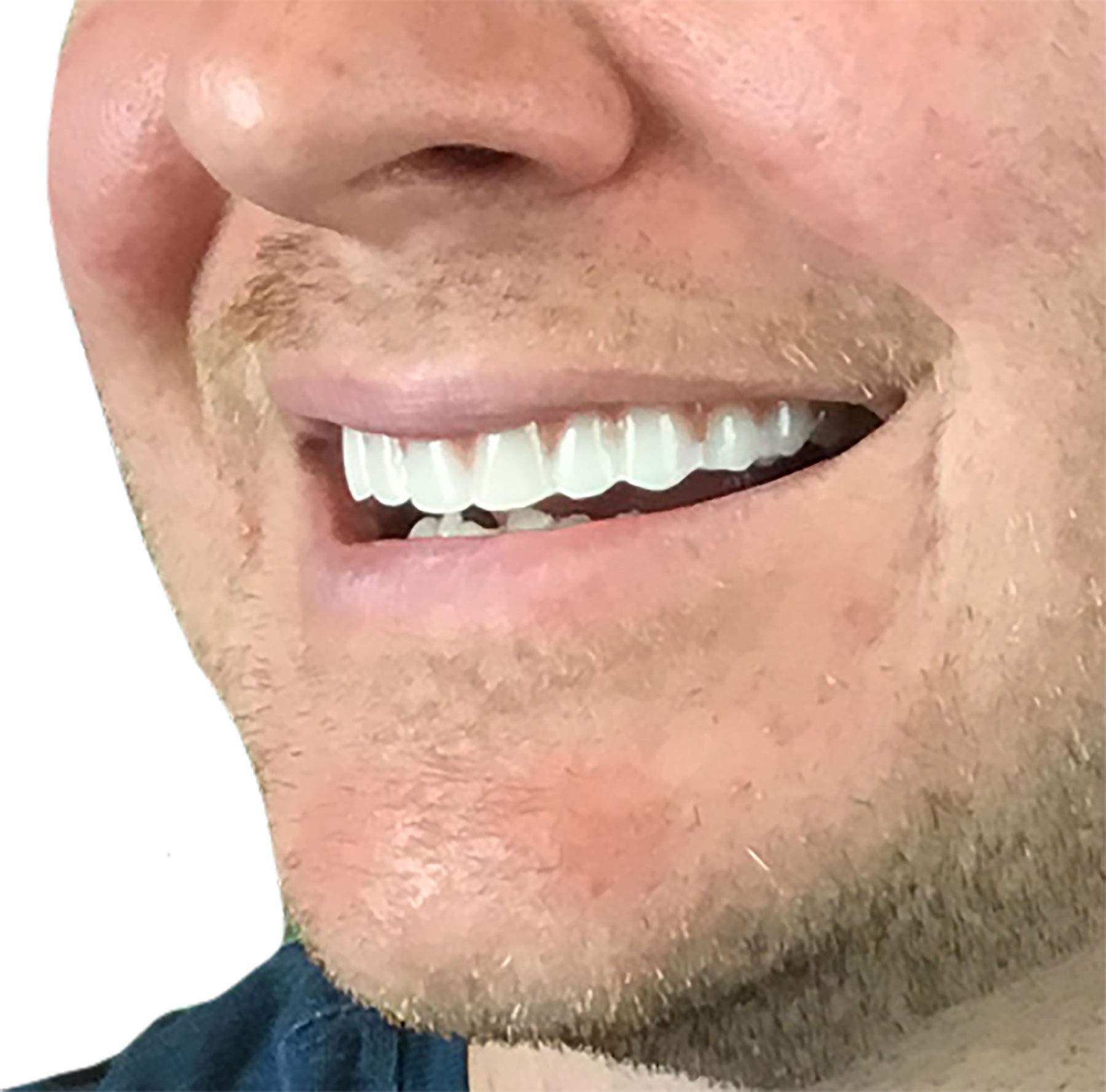 Instant Smile heat mold process showing remolding upper teeth for comfortable fit