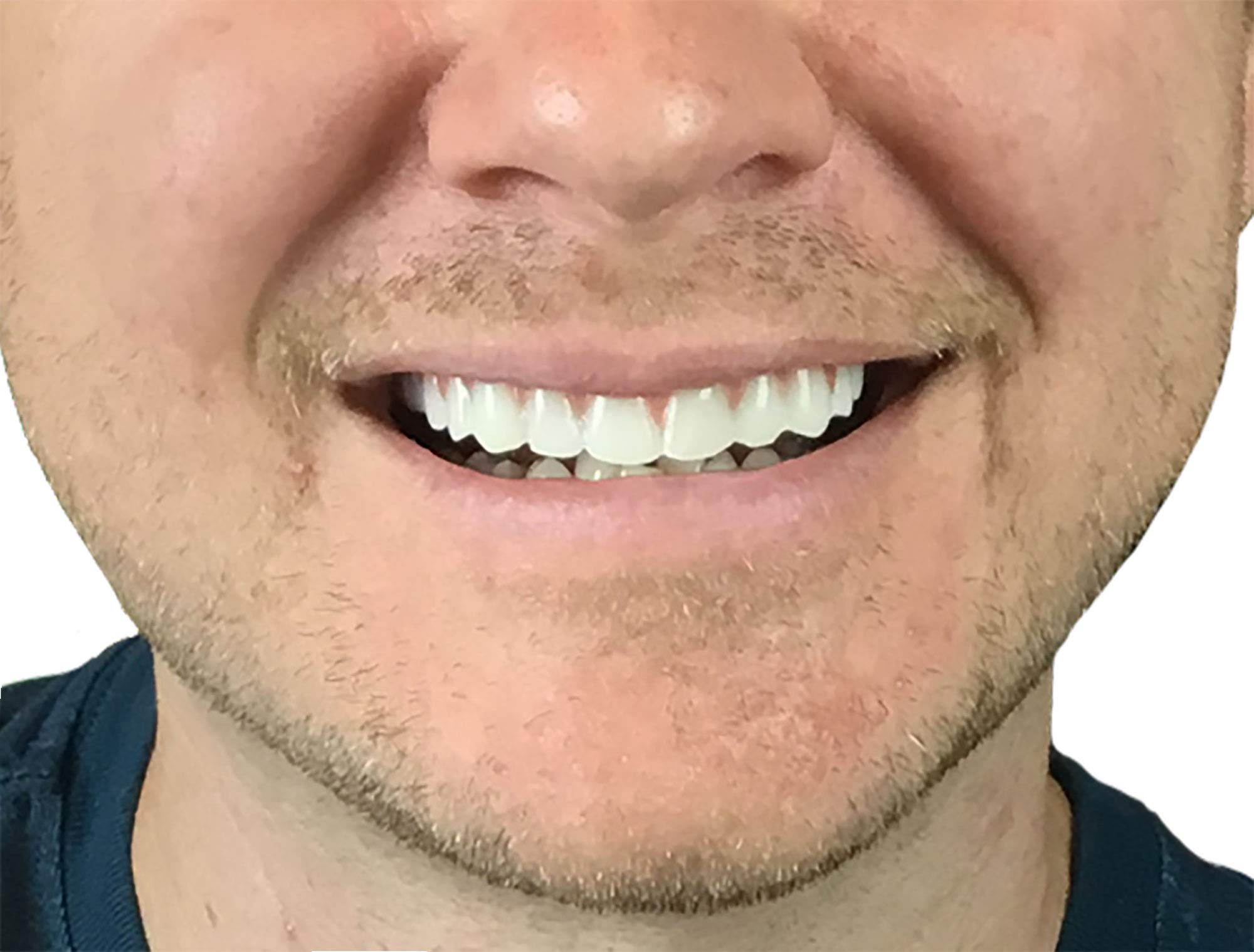 Instant Smile upper teeth placed over natural teeth for quick at home smile fix