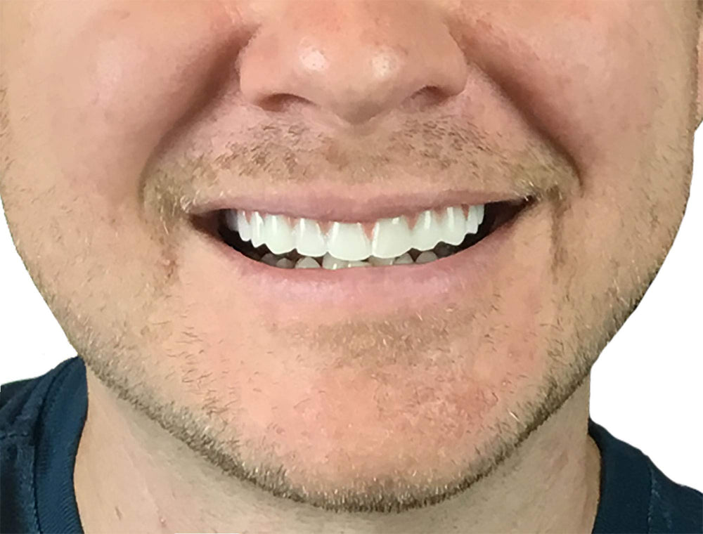 Instant Smile upper teeth placed over natural teeth for quick at home smile fix