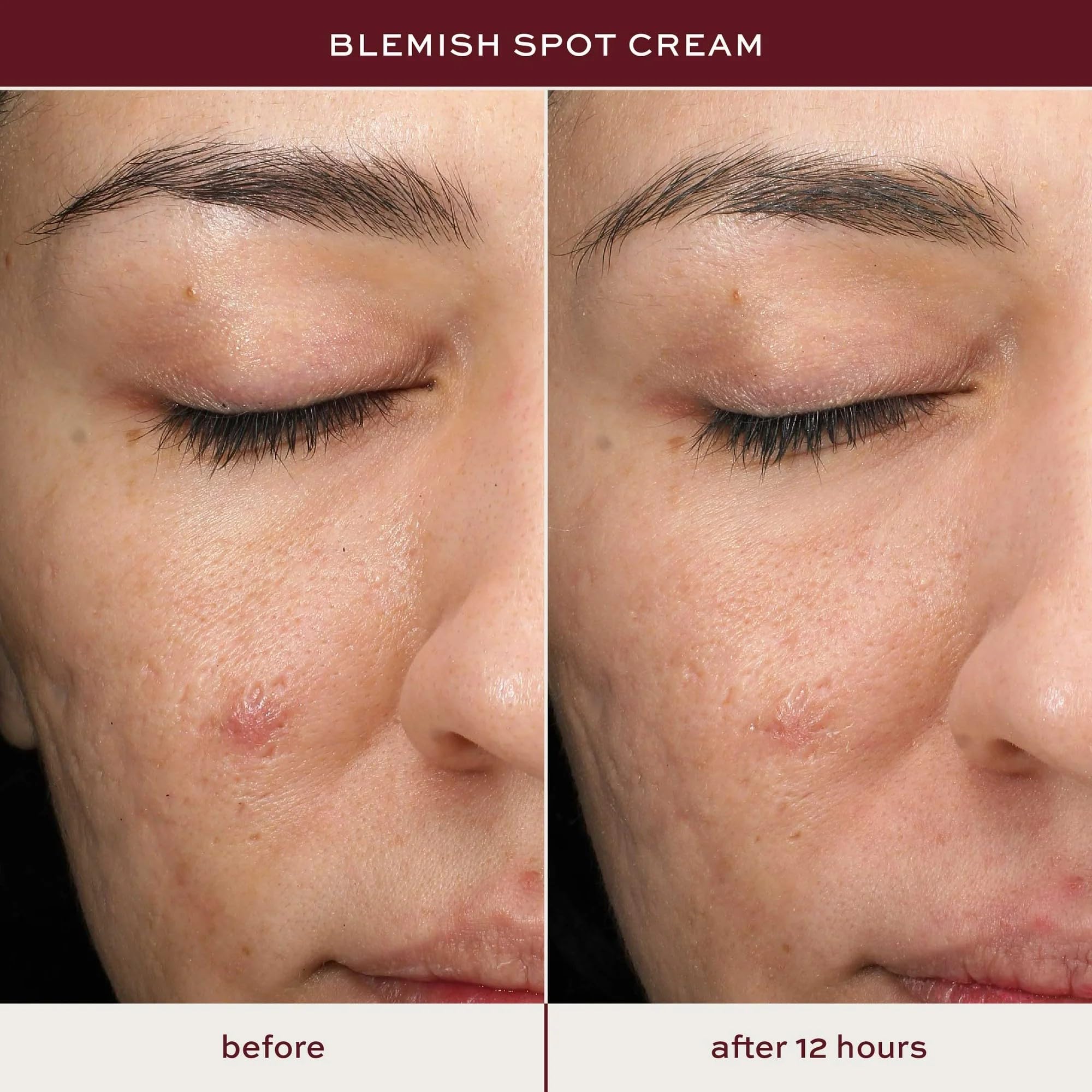 ITK Skincare close-up showing texture improvement after spot-treatment.