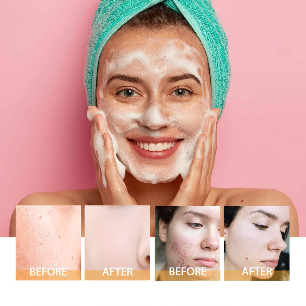 JISKG Acne blemish appearance improvement concept