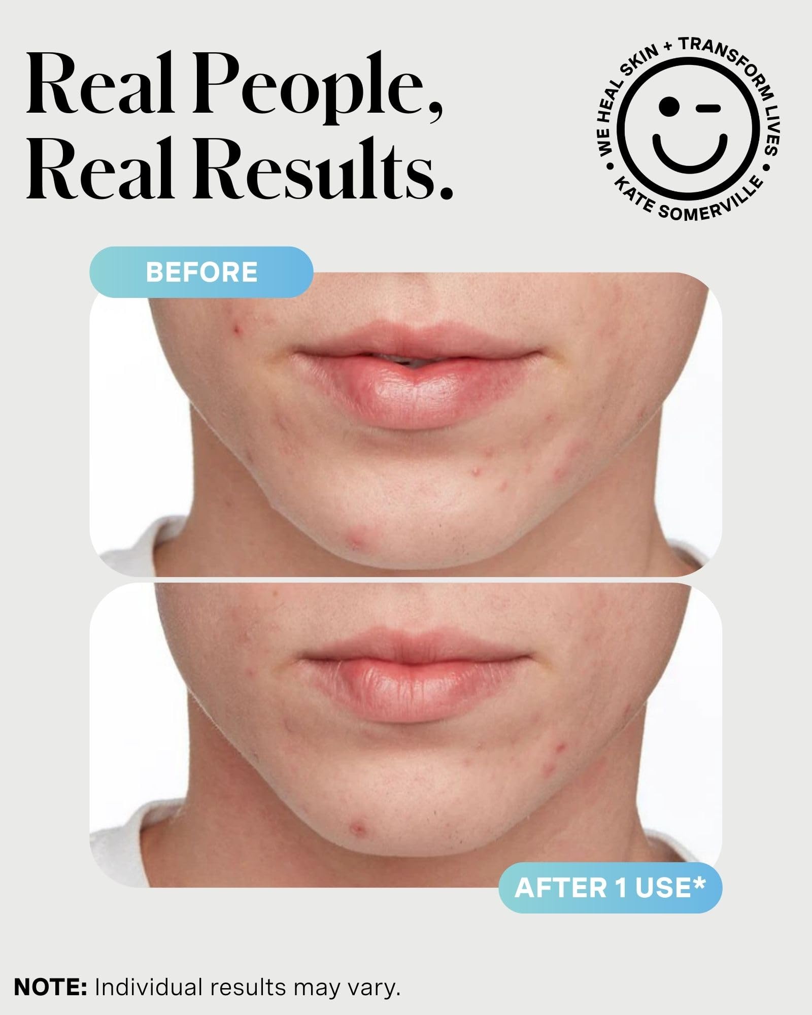 Zinc oxide in EradiKate helping absorb oil for clearer skin