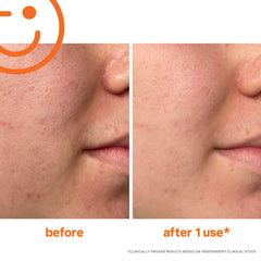 Kate Somerville Exfolikate ingredients featuring lactic and salicylic acids for refined pores