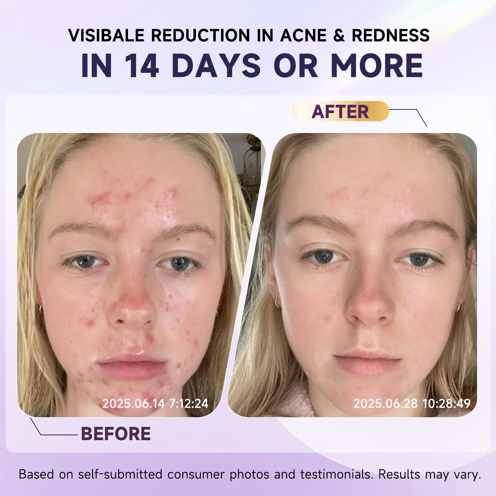Targeted application on acne spots using Kempc cream.