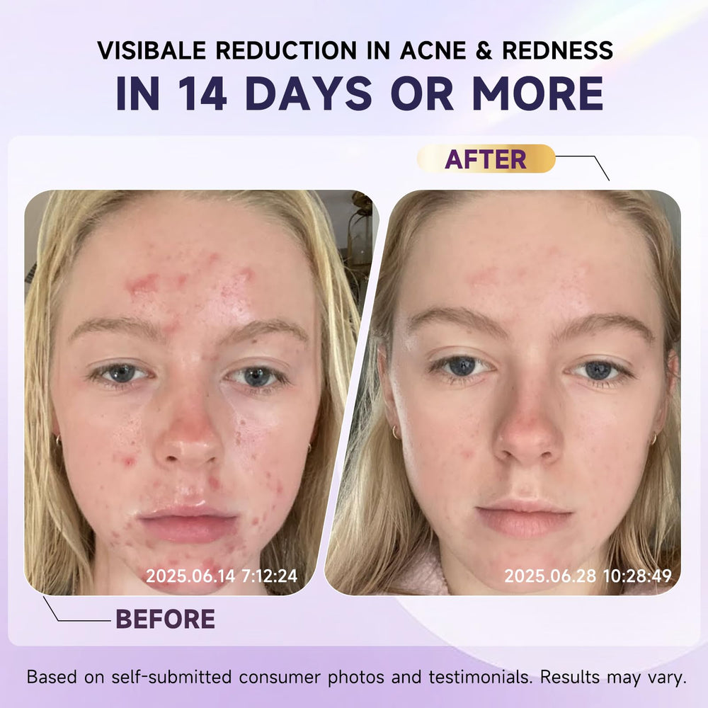 Targeted application on acne spots using Kempc cream.