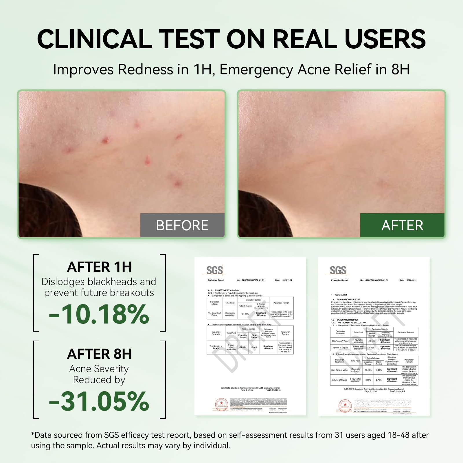 LANBENA 8H rapid acne action visual suggests quick blemish relief.