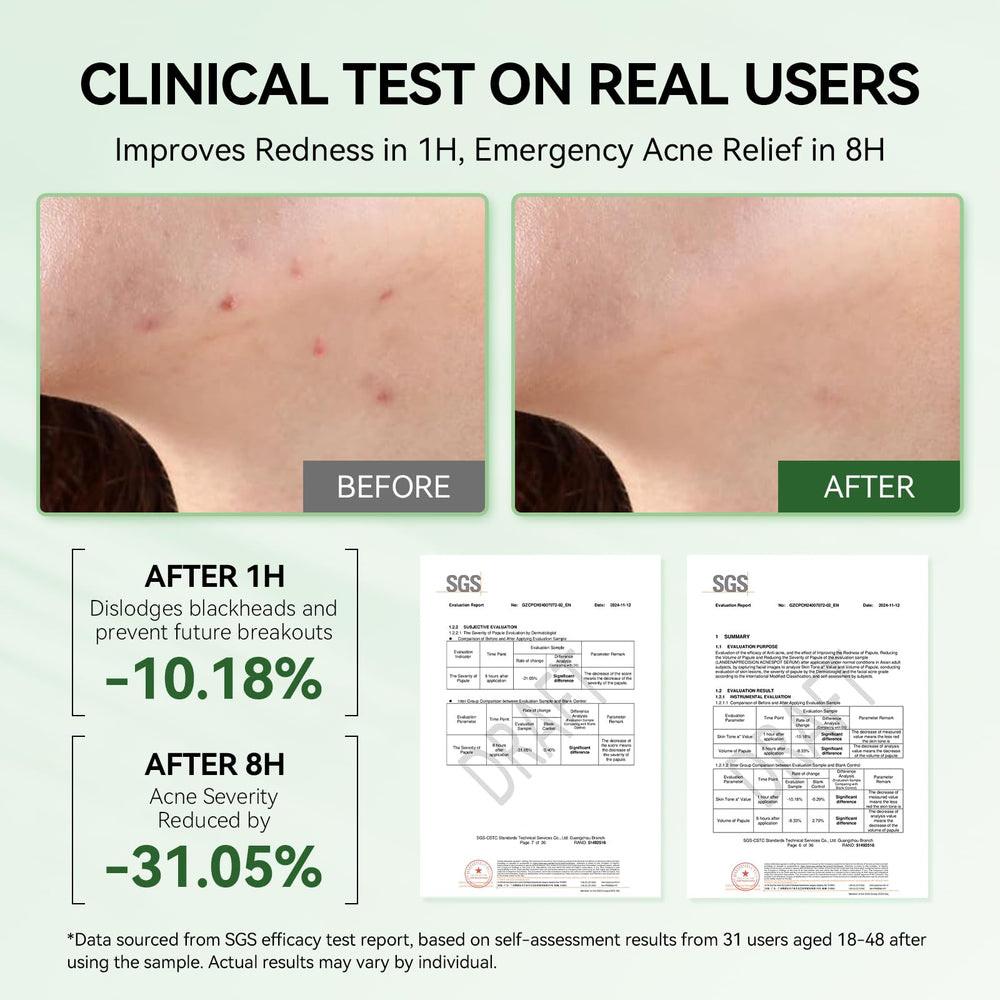 LANBENA 8H rapid acne action visual suggests quick blemish relief.