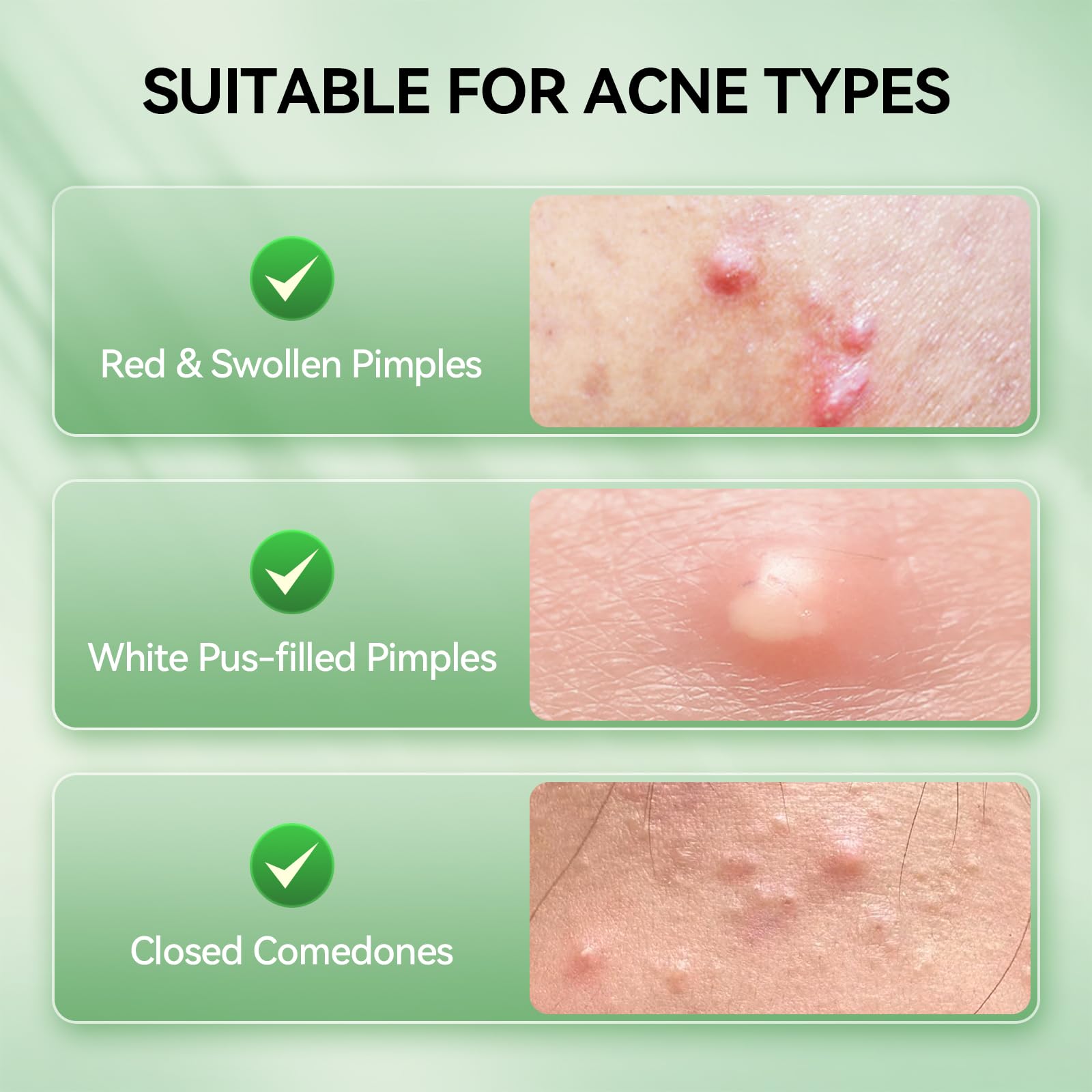 LANBENA Niacinamide ingredient highlight supports skin clarity around blemishes.