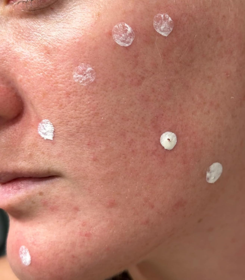 LANBENA spot serum application swabs enable precise direct-to-pimple treatment.