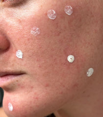 LANBENA spot serum application swabs enable precise direct-to-pimple treatment.