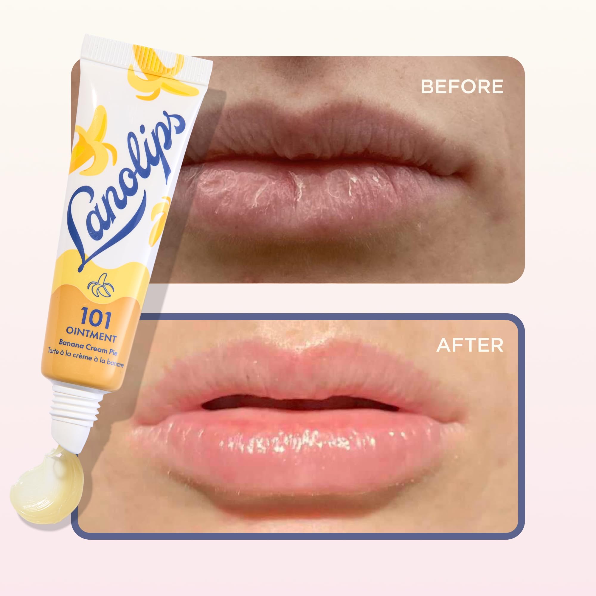 Lanolips 101 Ointment on cuticles offers conditioning and relief.