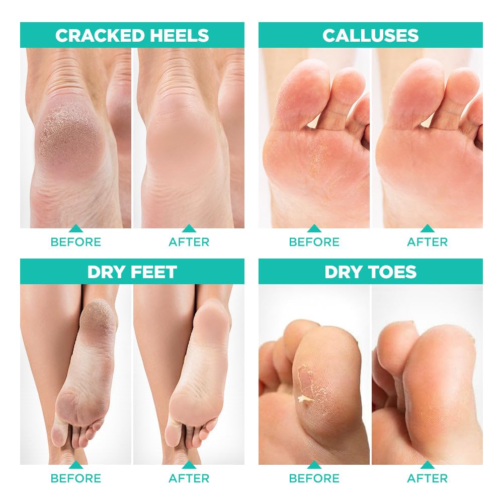 Lavinso foot peel mask worn on feet during application for at-home exfoliation