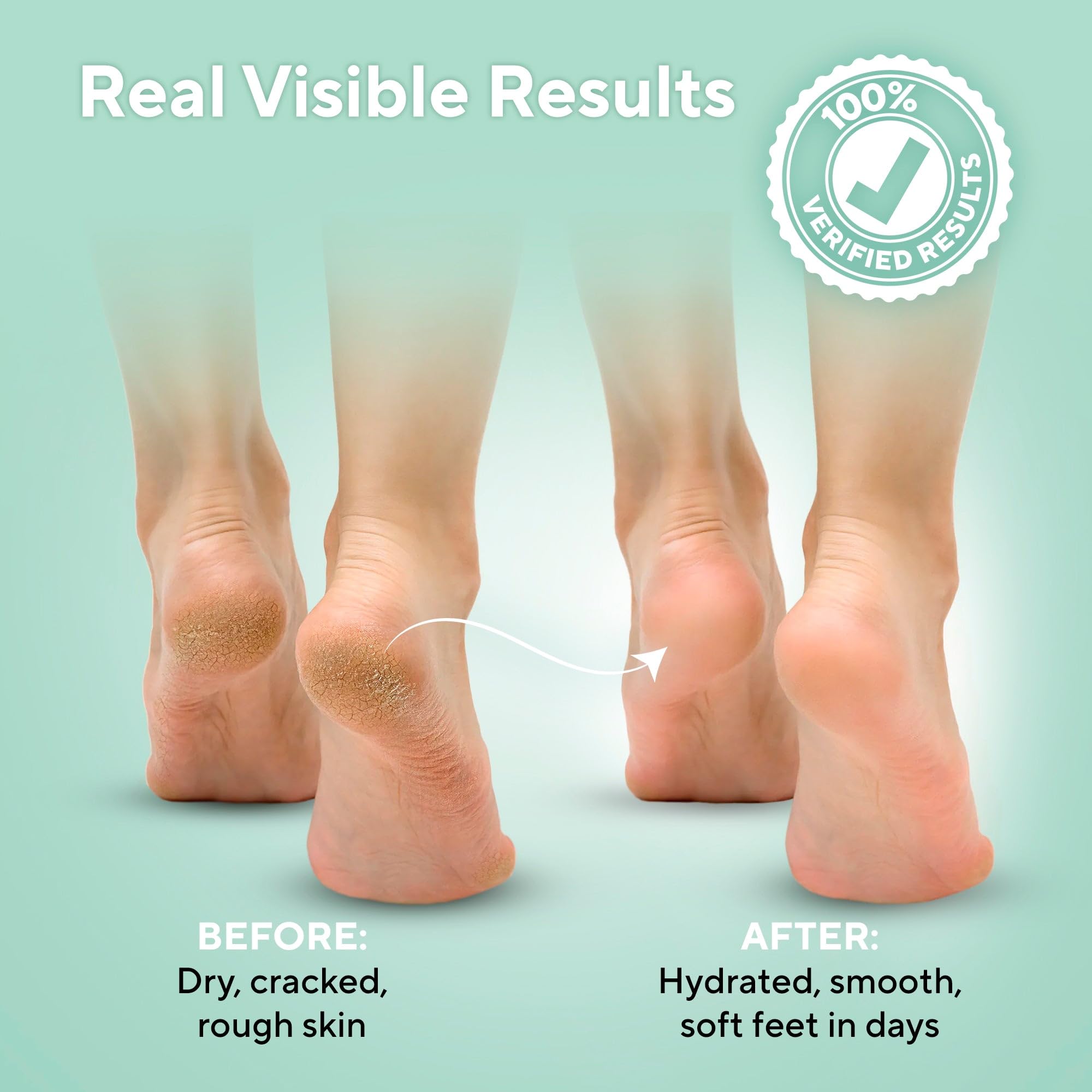 LV Lavinso Urea Cream 40% cracked heels closeup shows softening effect.