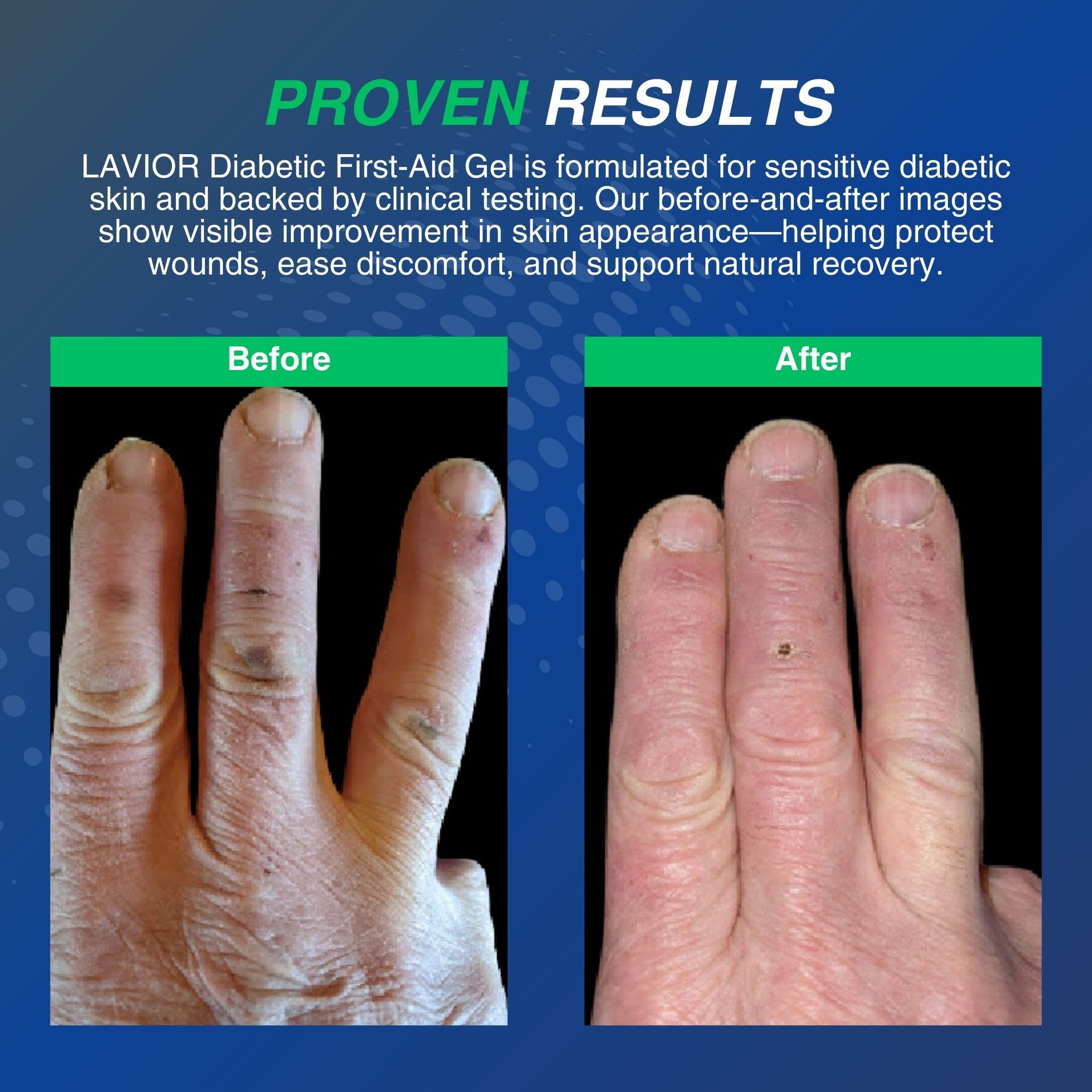 Lavior Diabetic First-Aid Gel contains benzalkonium chloride for infection protection.