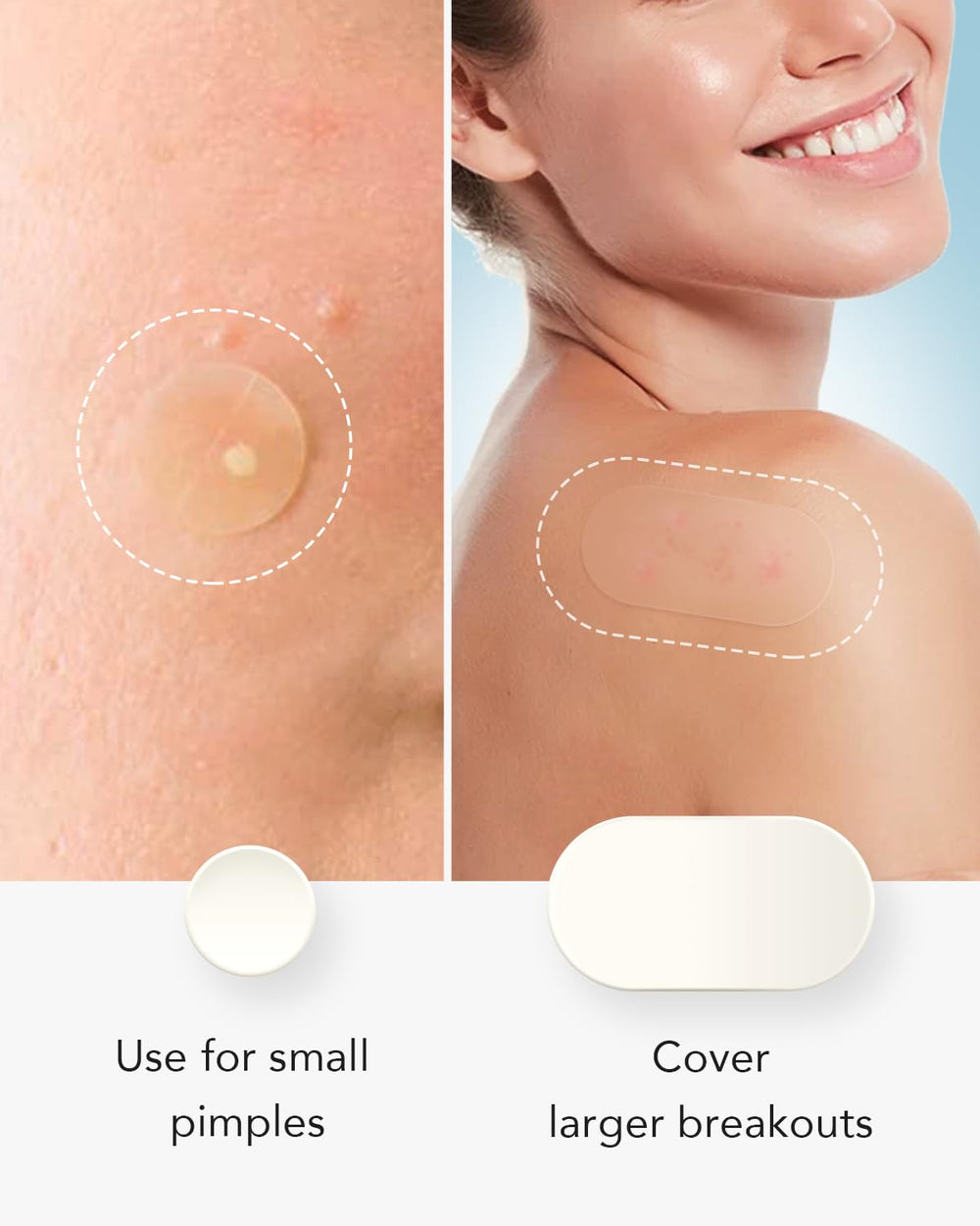 LitBear patches shown on back for versatile body acne use.