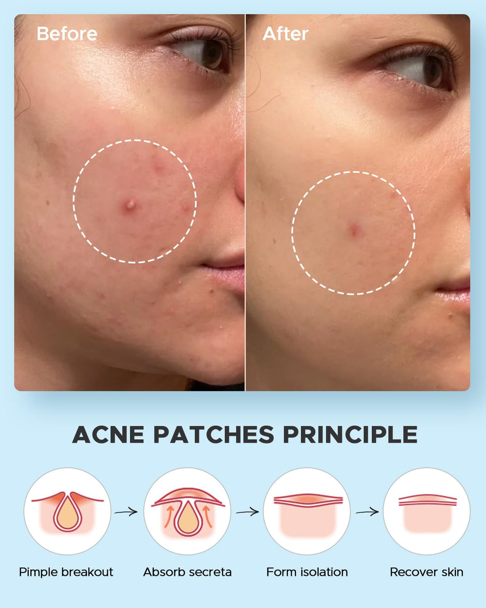 Witch hazel ingredient highlights soothing care in LitBear patches