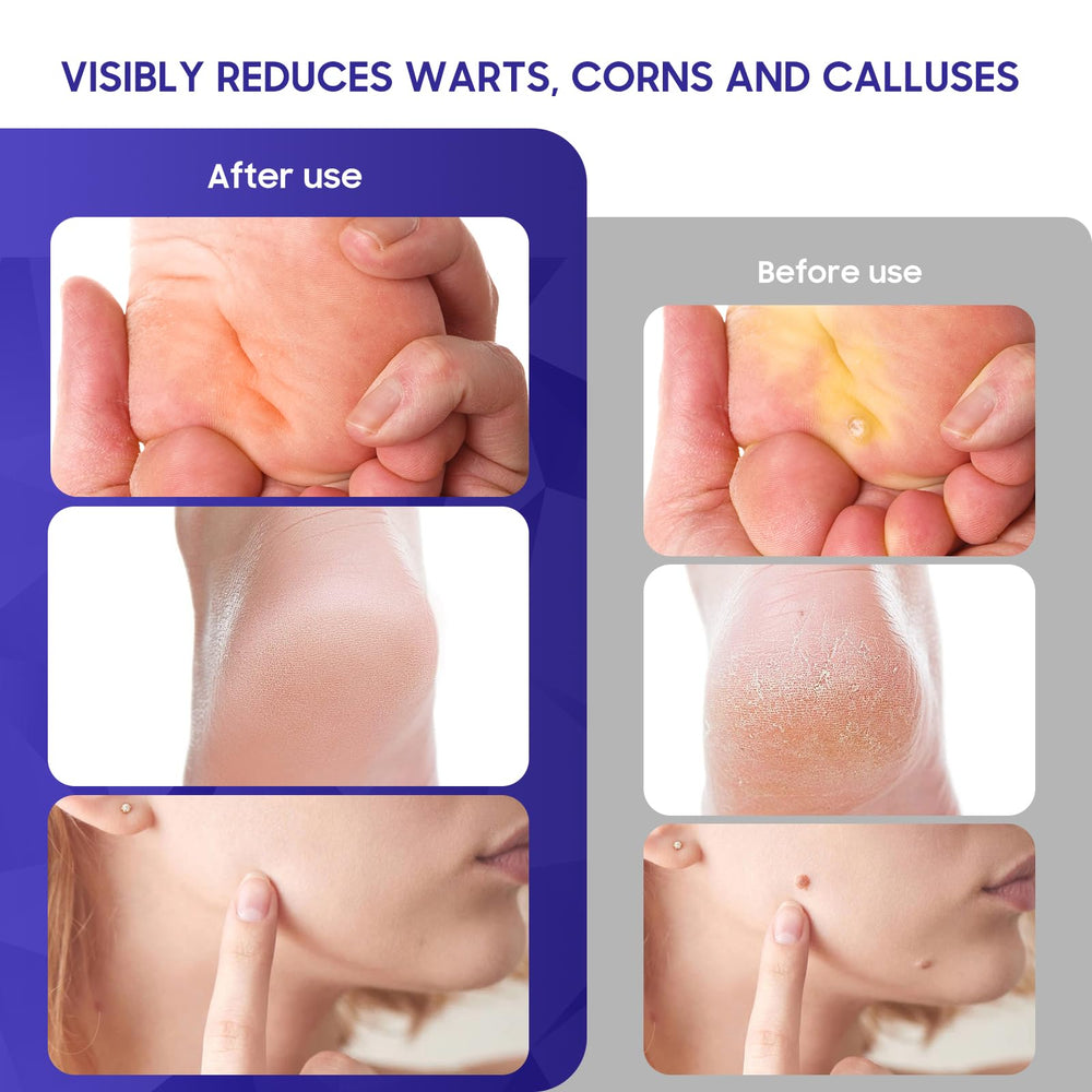 Luanerl Maximum Strength Formula delivers potent penetration for stubborn warts.