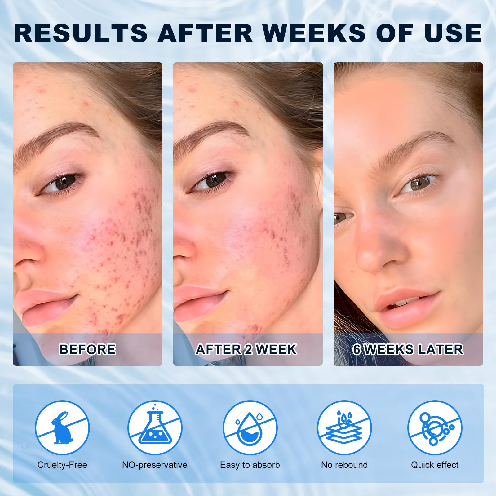 Marianp Azelaic Acid 10% Cream closeup demonstrates gentle formula