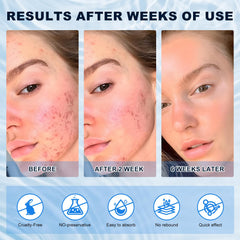 Marianp Azelaic Acid 10% Cream closeup demonstrates gentle formula