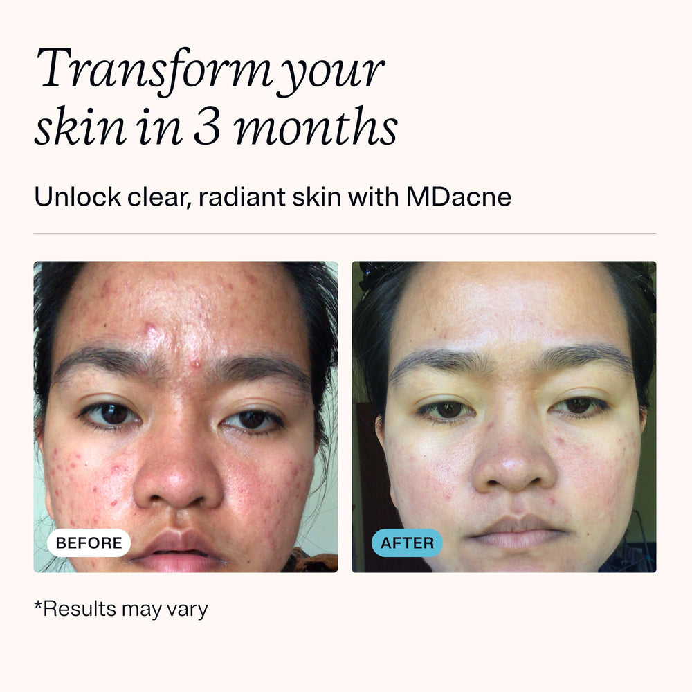 MDacne salicylic cleanser 0.5% in bottle helps clear pores