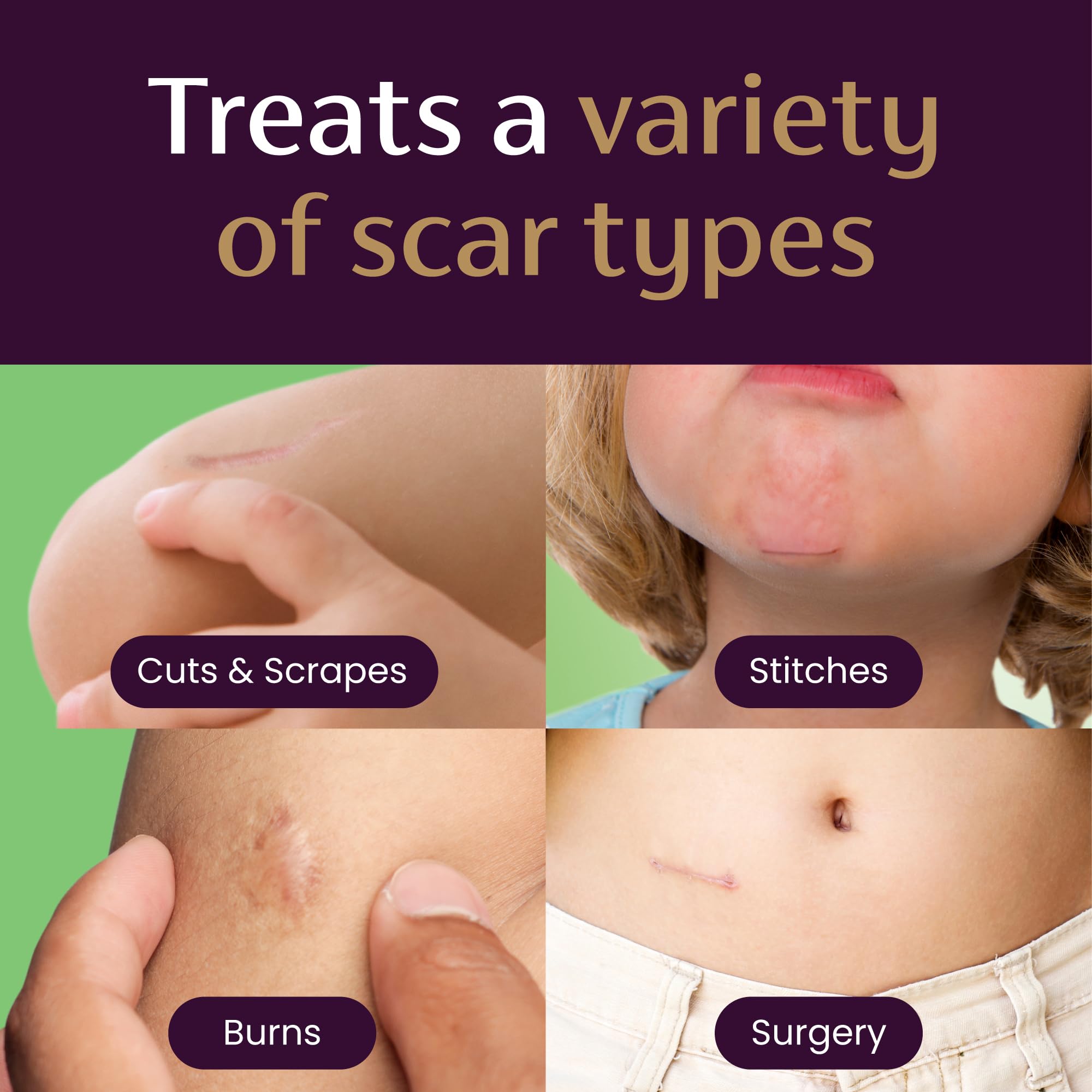 Mederma Kids purple-to-clear application demonstrates easy, mess-free use after minor injuries.