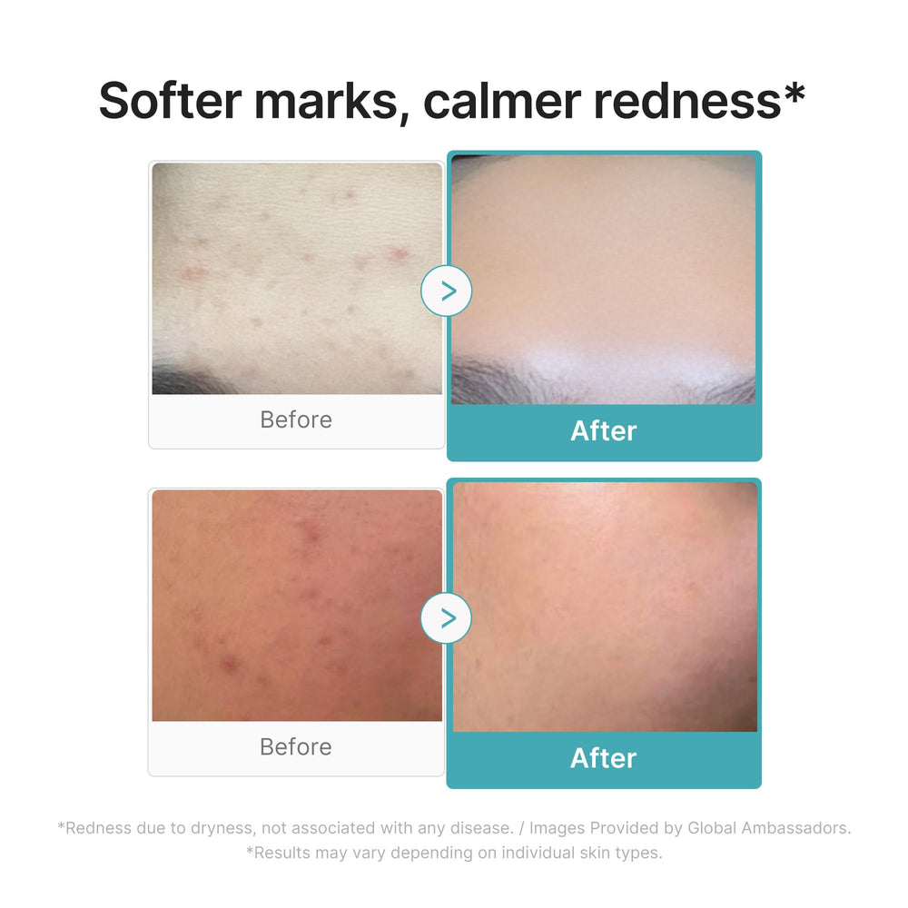 Medicube Azelaic Acid 10 soothing serum on face highlights a light, refreshing feel.