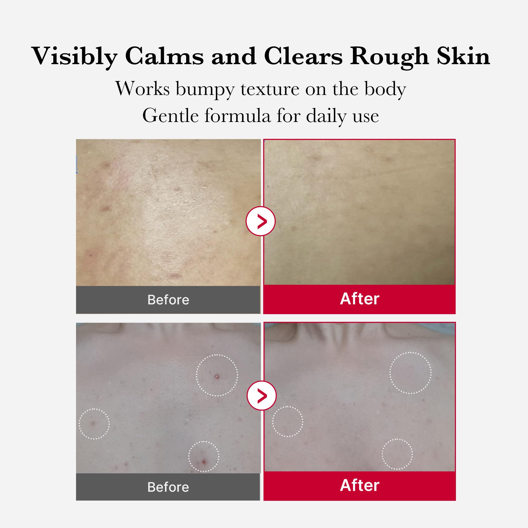 Application on shoulder using Medicube Red Body Peeling Shot for targeted exfoliation.