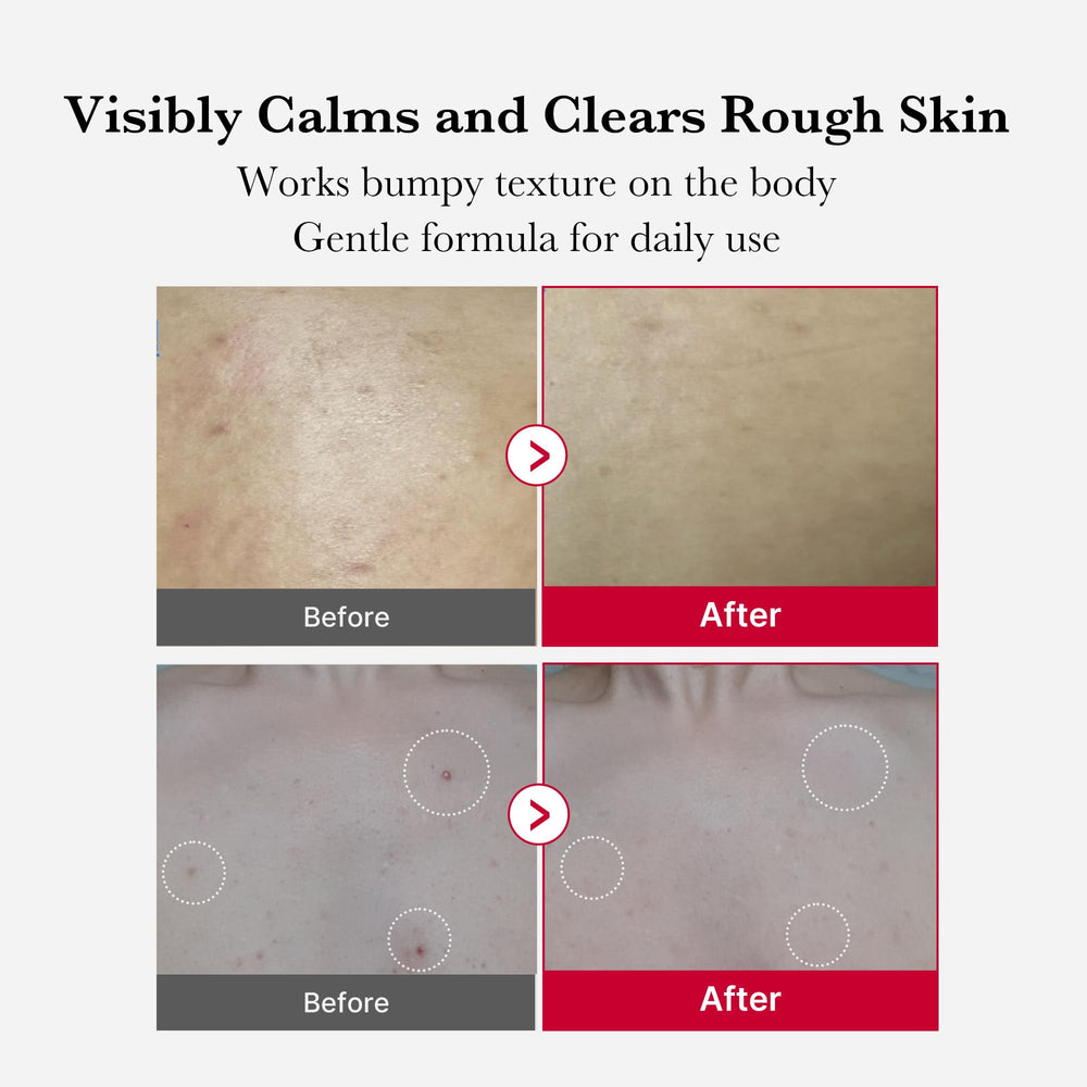 Application on shoulder using Medicube Red Body Peeling Shot for targeted exfoliation.