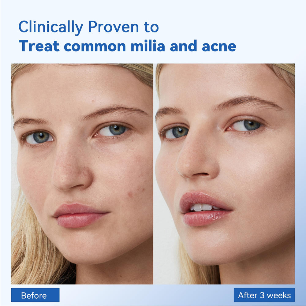 MEOLY Milia Remover Serum application dropper; precise dispensing for targeted treatment.