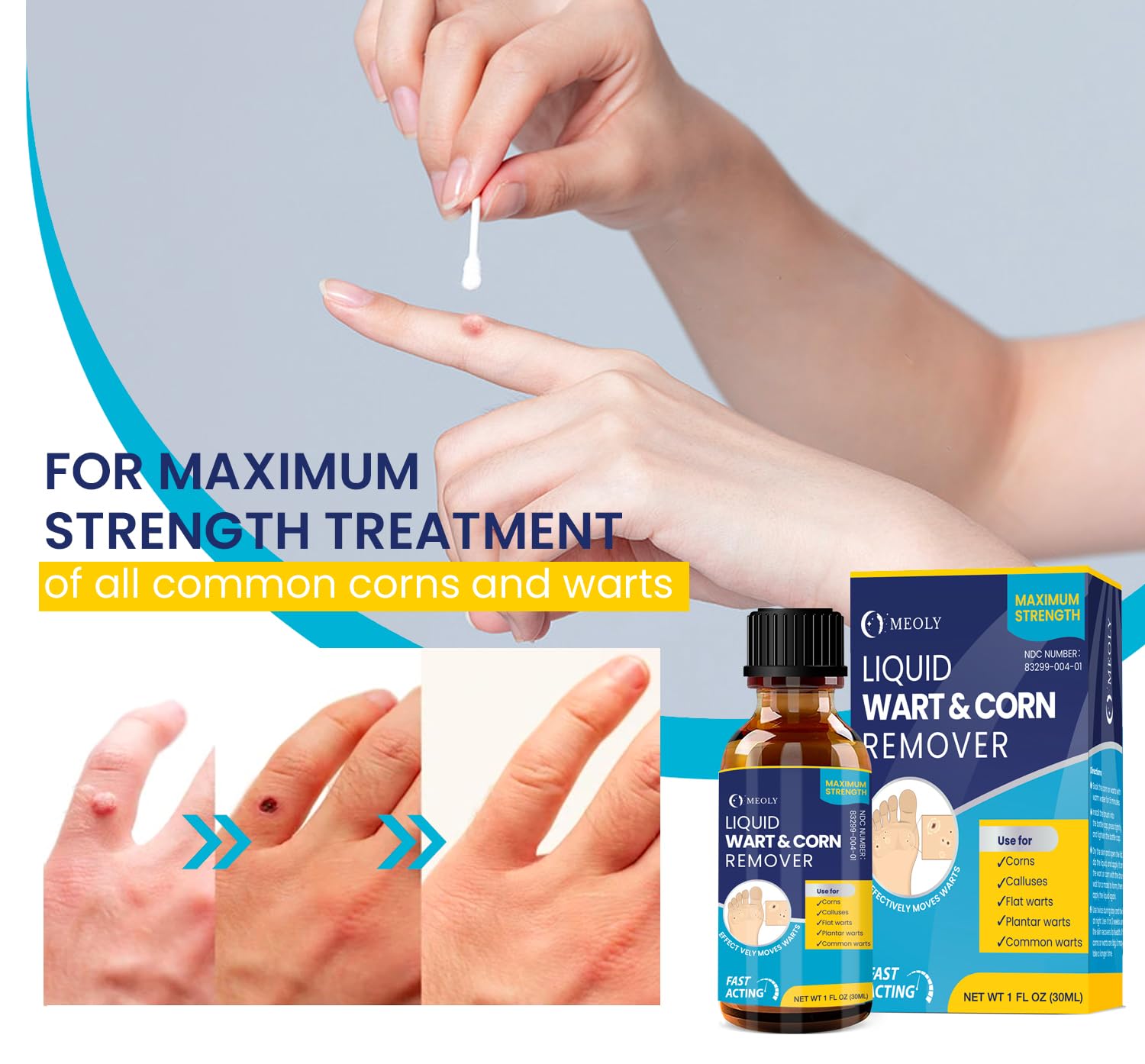 MEOLY plantar wart treatment on foot enables at-home use.