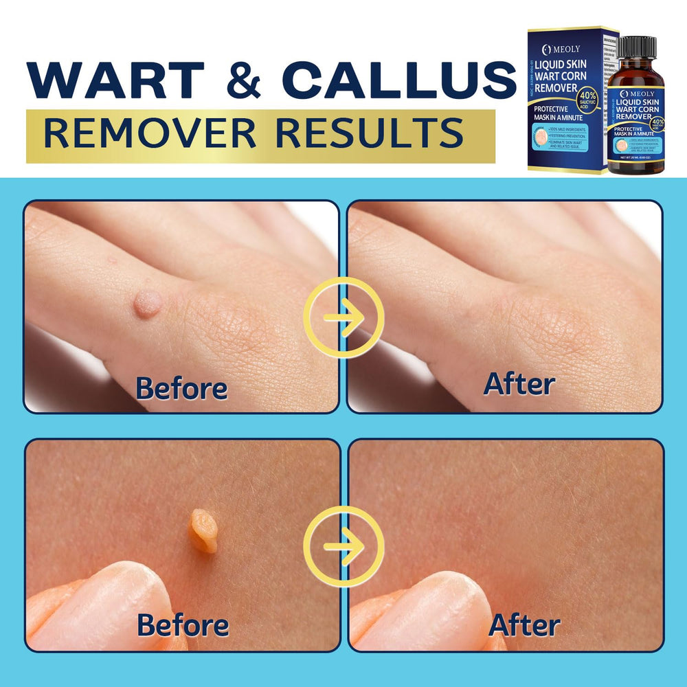 MEOLY plantar wart treatment steps image illustrates at-home care options.