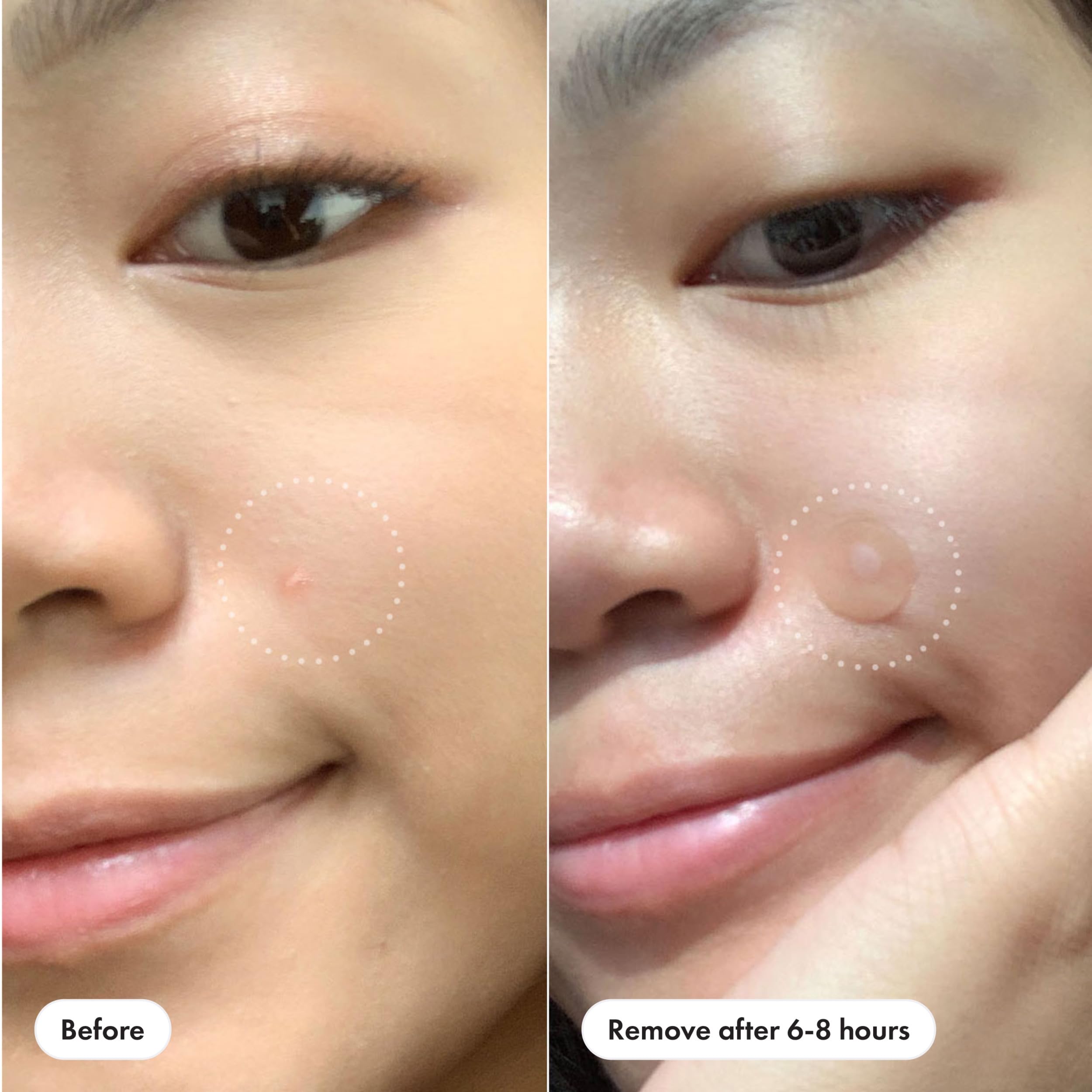 Mighty Patch Original blends seamlessly with skin for discreet wear.