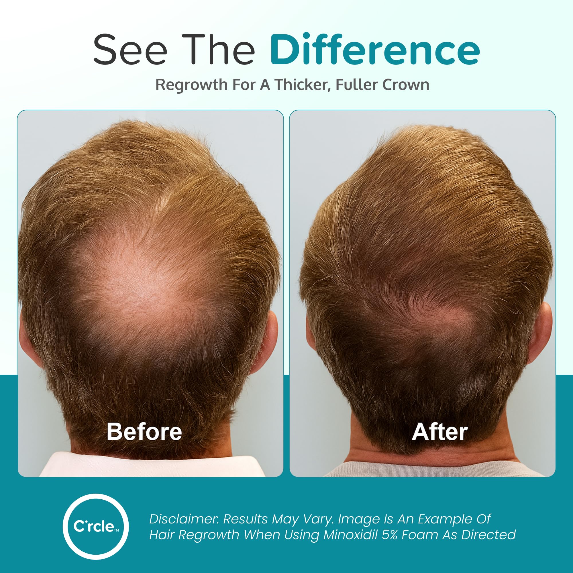C'rcle Minoxidil 5% Foam provides even coverage on thinning areas.