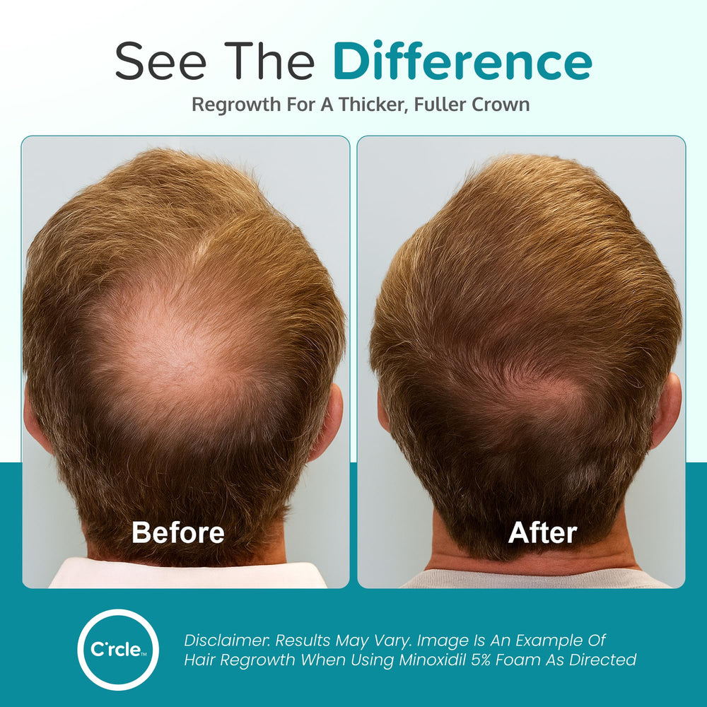 C'rcle Minoxidil 5% Foam provides even coverage on thinning areas.