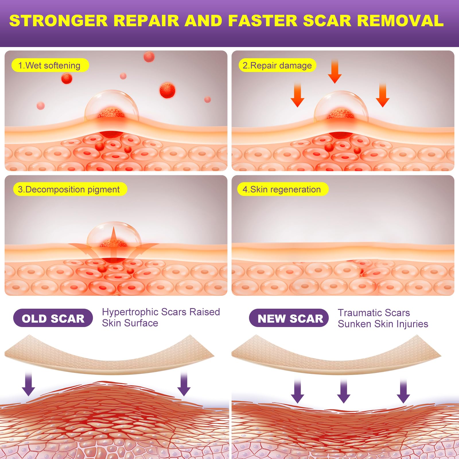 MUKBEA scar strip on keloid bump area with smooth, flexible silicone.