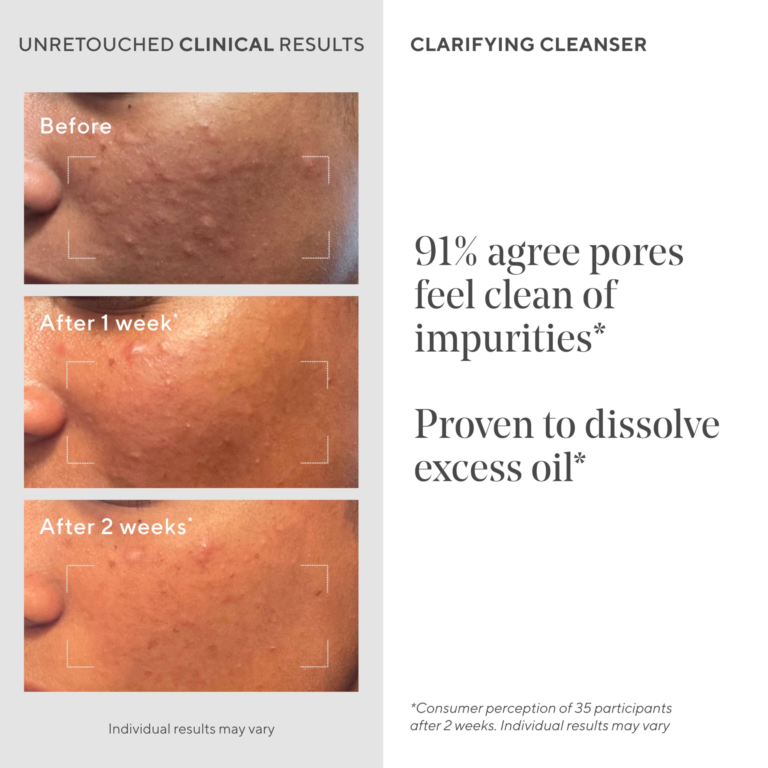 Murad Acne Control Clarifying Cleanser encapsulated salicylic acid beads continue to work after rinse