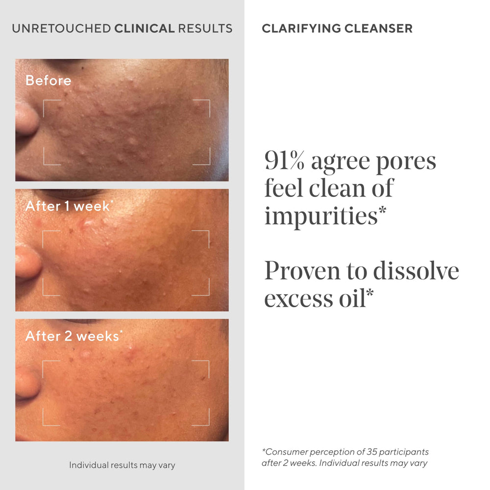 Murad Acne Control Clarifying Cleanser encapsulated salicylic acid beads continue to work after rinse