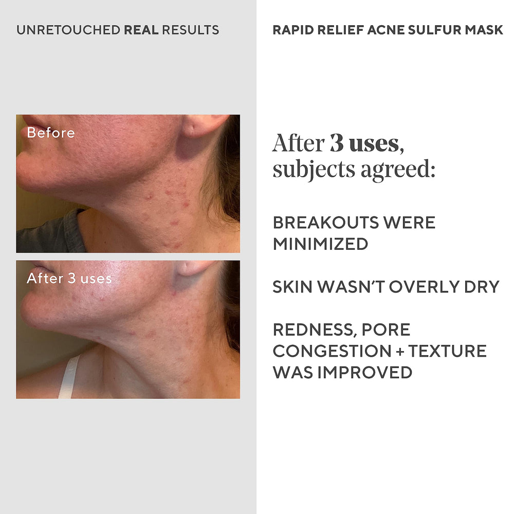 Murad Rapid Relief Acne Sulfur Mask applying on face during routine night.