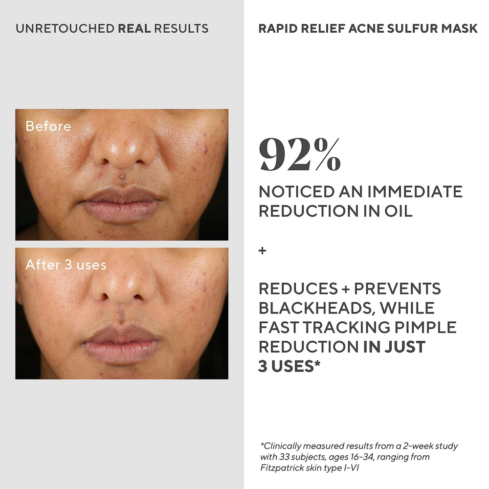 Murad Rapid Relief Acne Sulfur Mask Austrian peat extract highlighted for redness reduction.