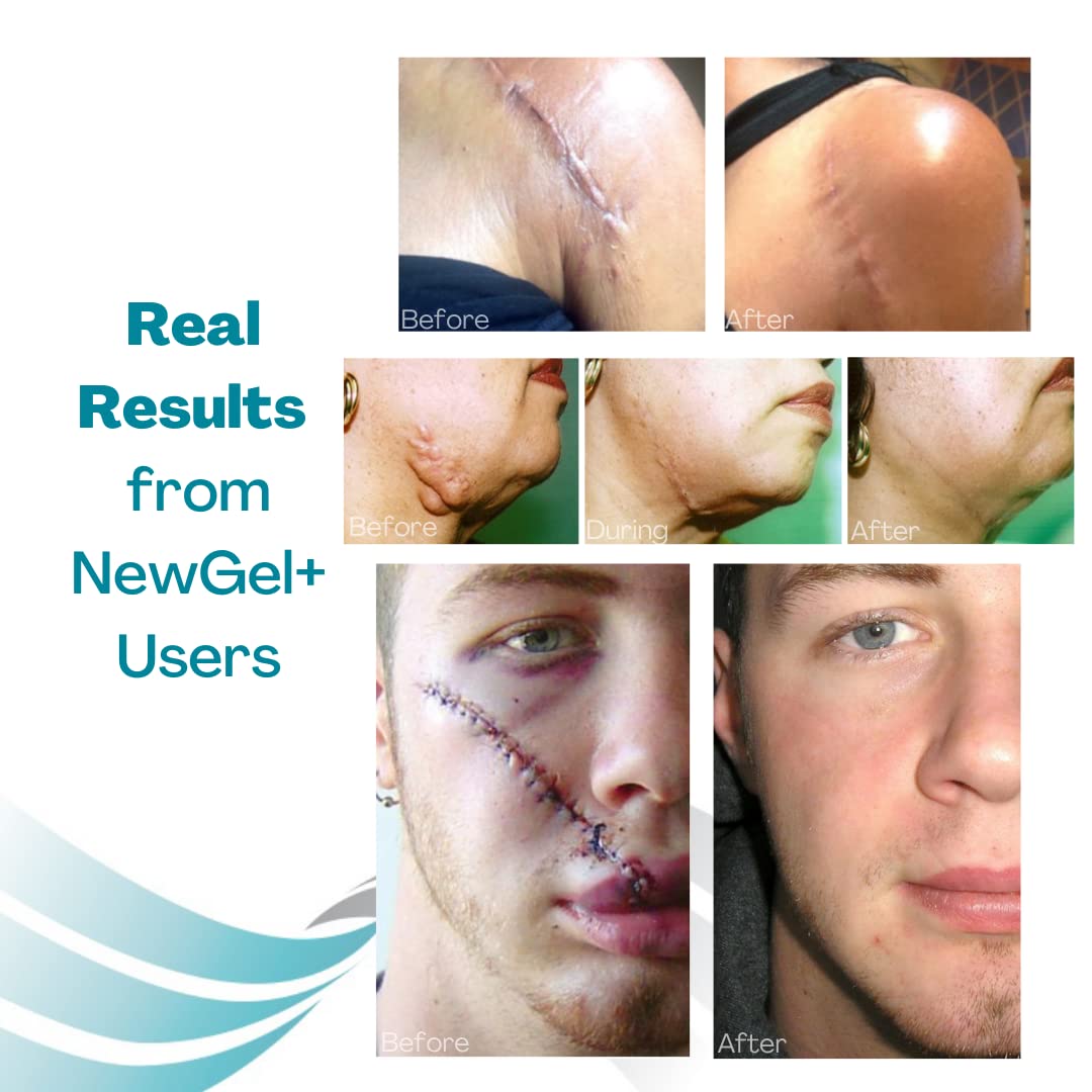 MyNewGel sheet works on burns and acne scars gently.